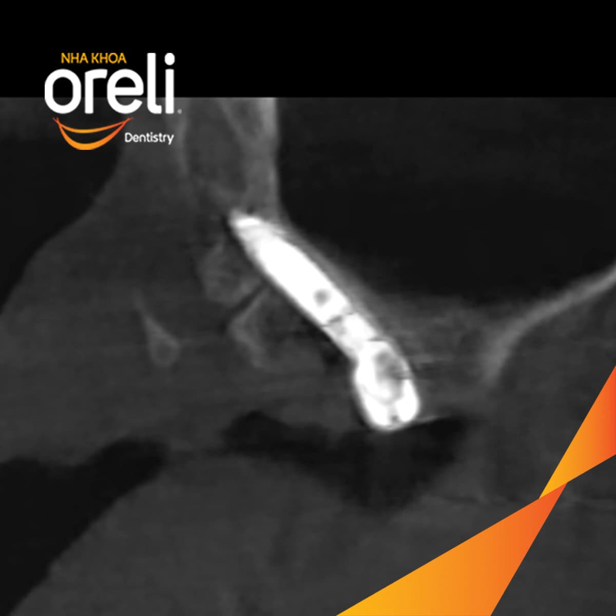 cay ghep implant toan ham chan buom nha khoa oreli