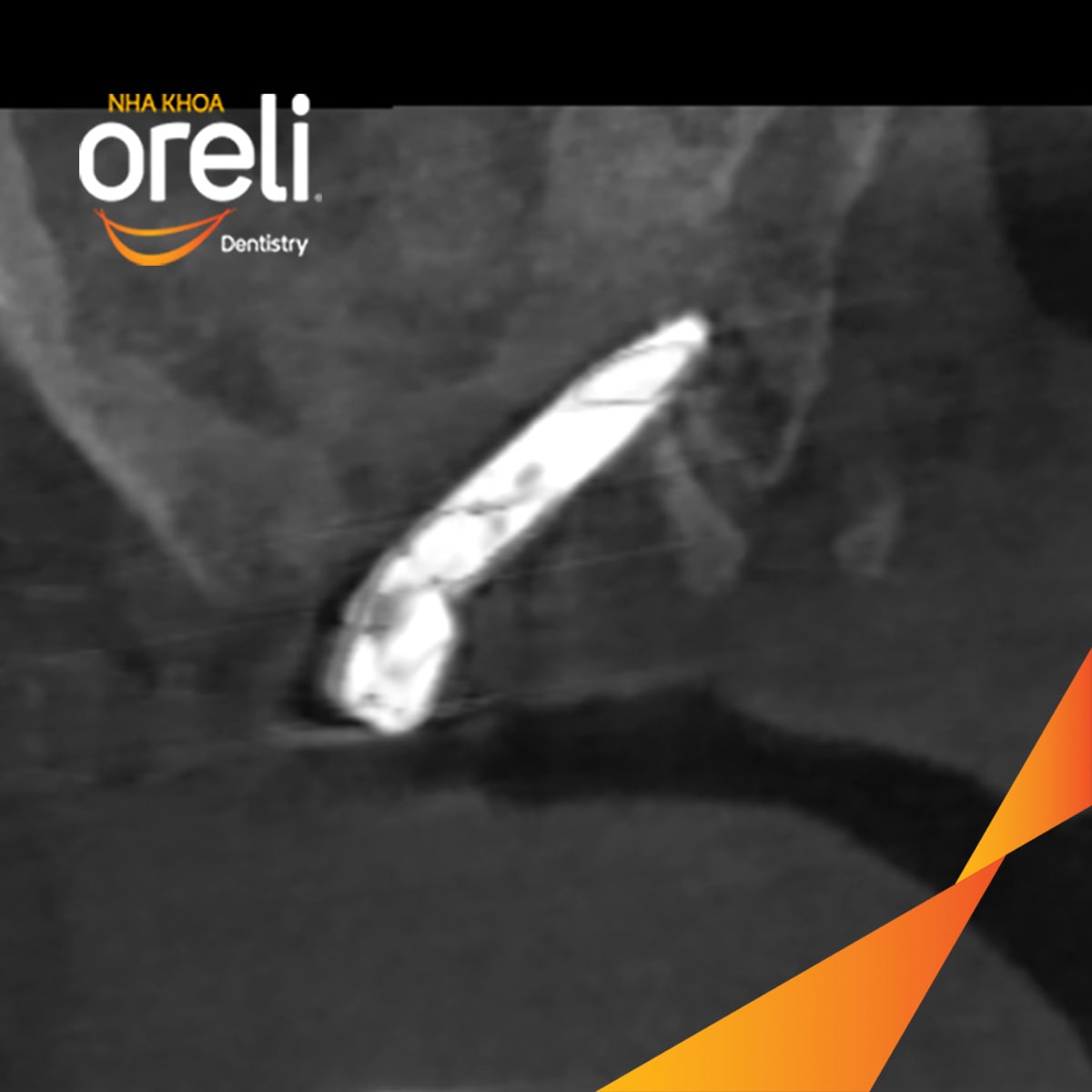 cay ghep implant toan ham chan buom nha khoa oreli