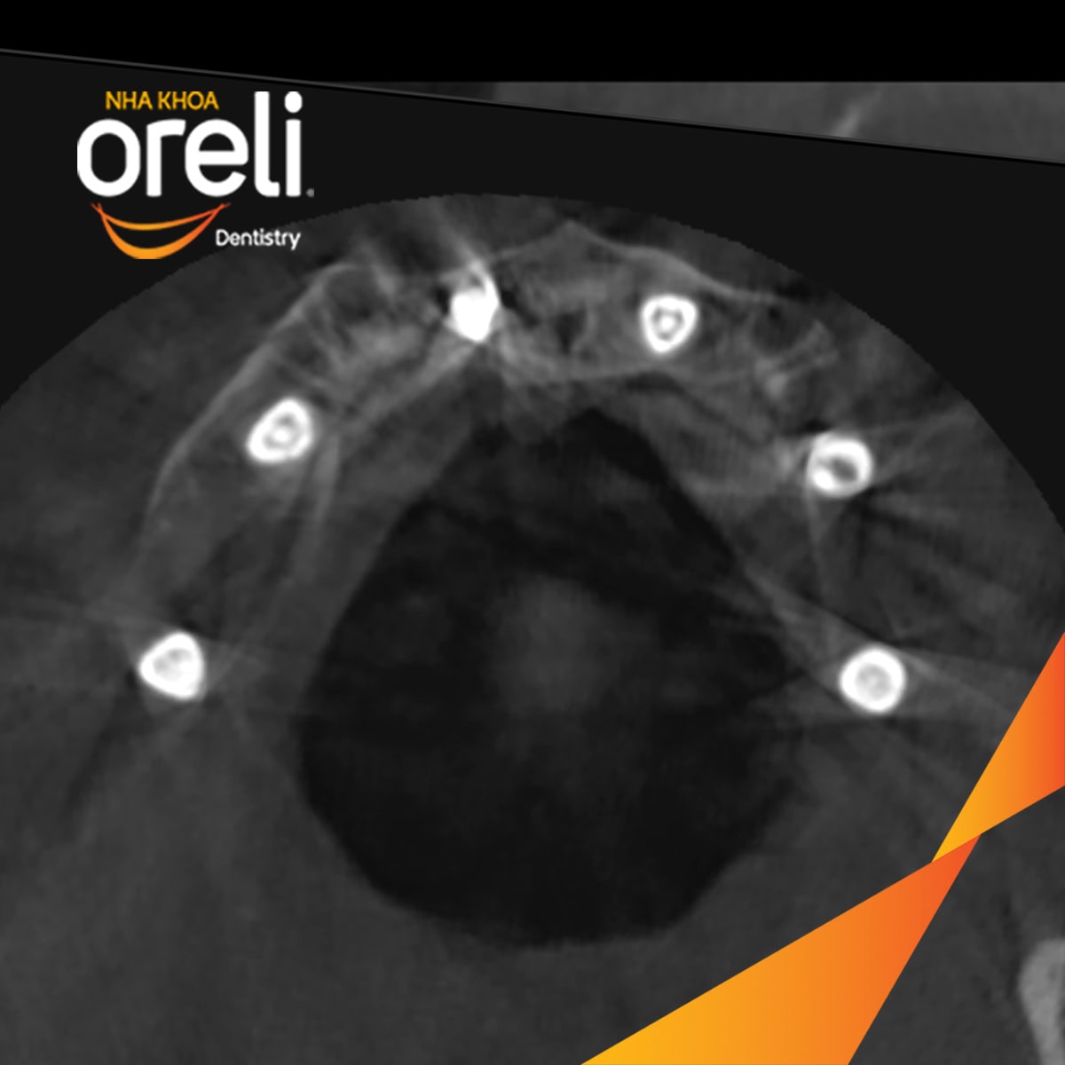 cay ghep implant toan ham chan buom nha khoa oreli