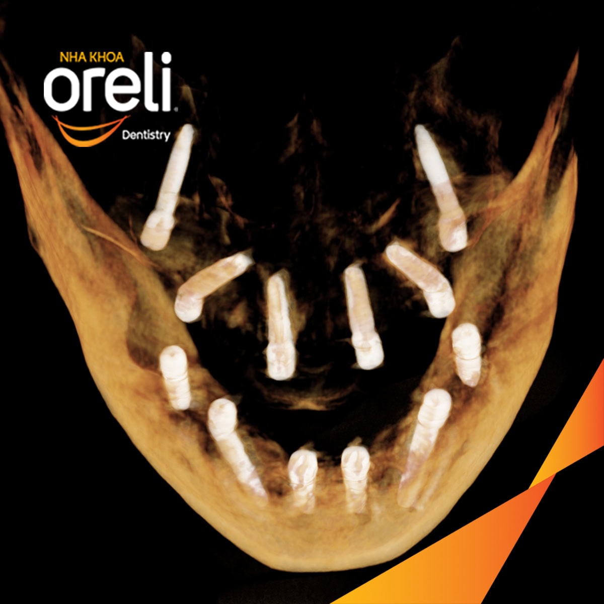 cay ghep implant toan ham chan buom nha khoa oreli