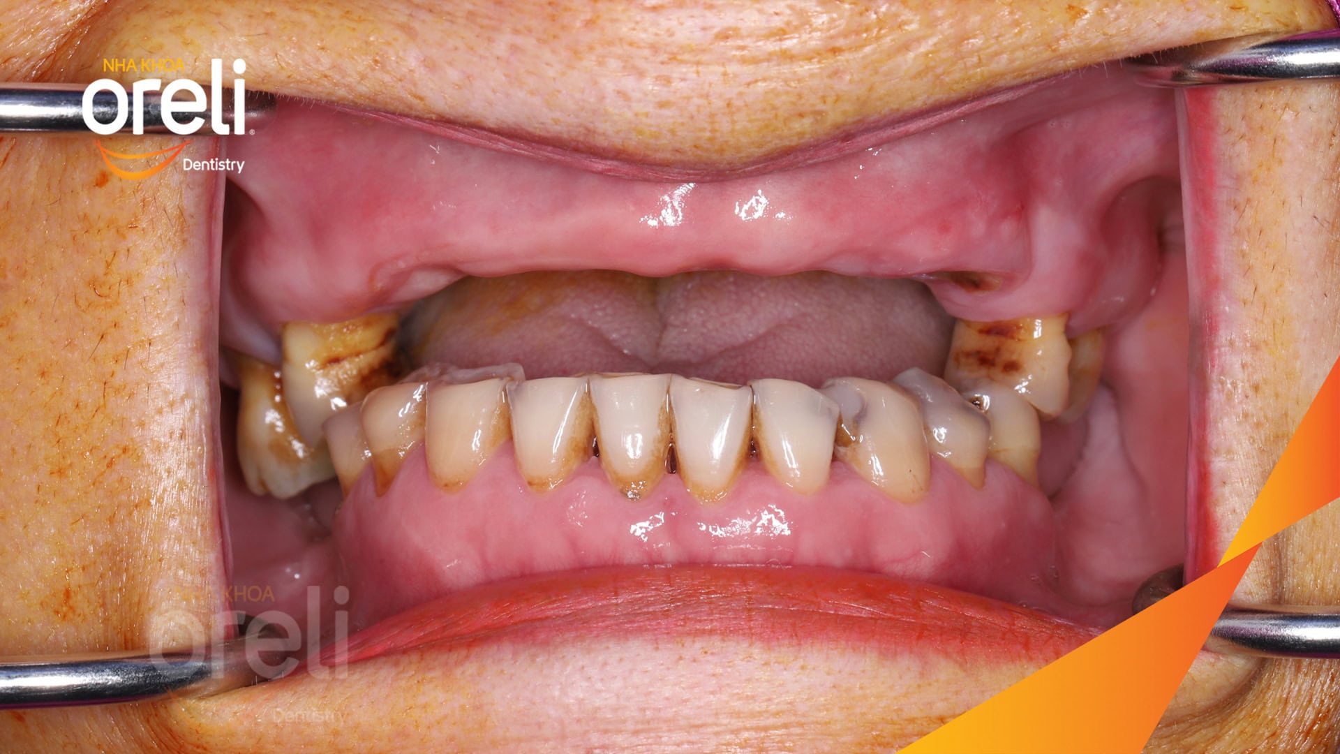 cay ghep implant toan ham tren veneer nha khoa oreli