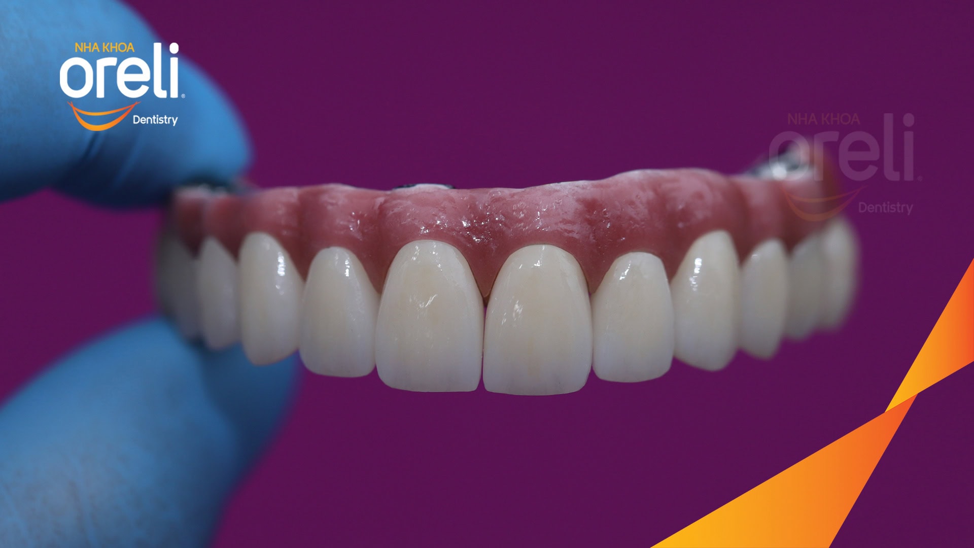 cay ghep implant toan ham tren veneer nha khoa oreli