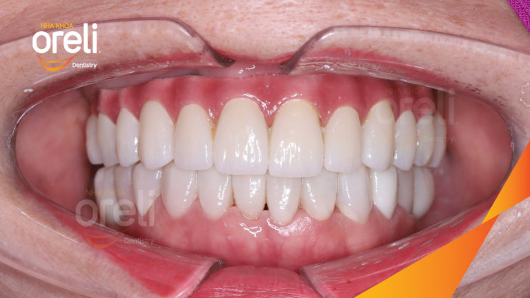 Trồng răng Implant hàm trên + Veneer hàm dưới – Phục hồi thẩm mỹ toàn diện | Oreli