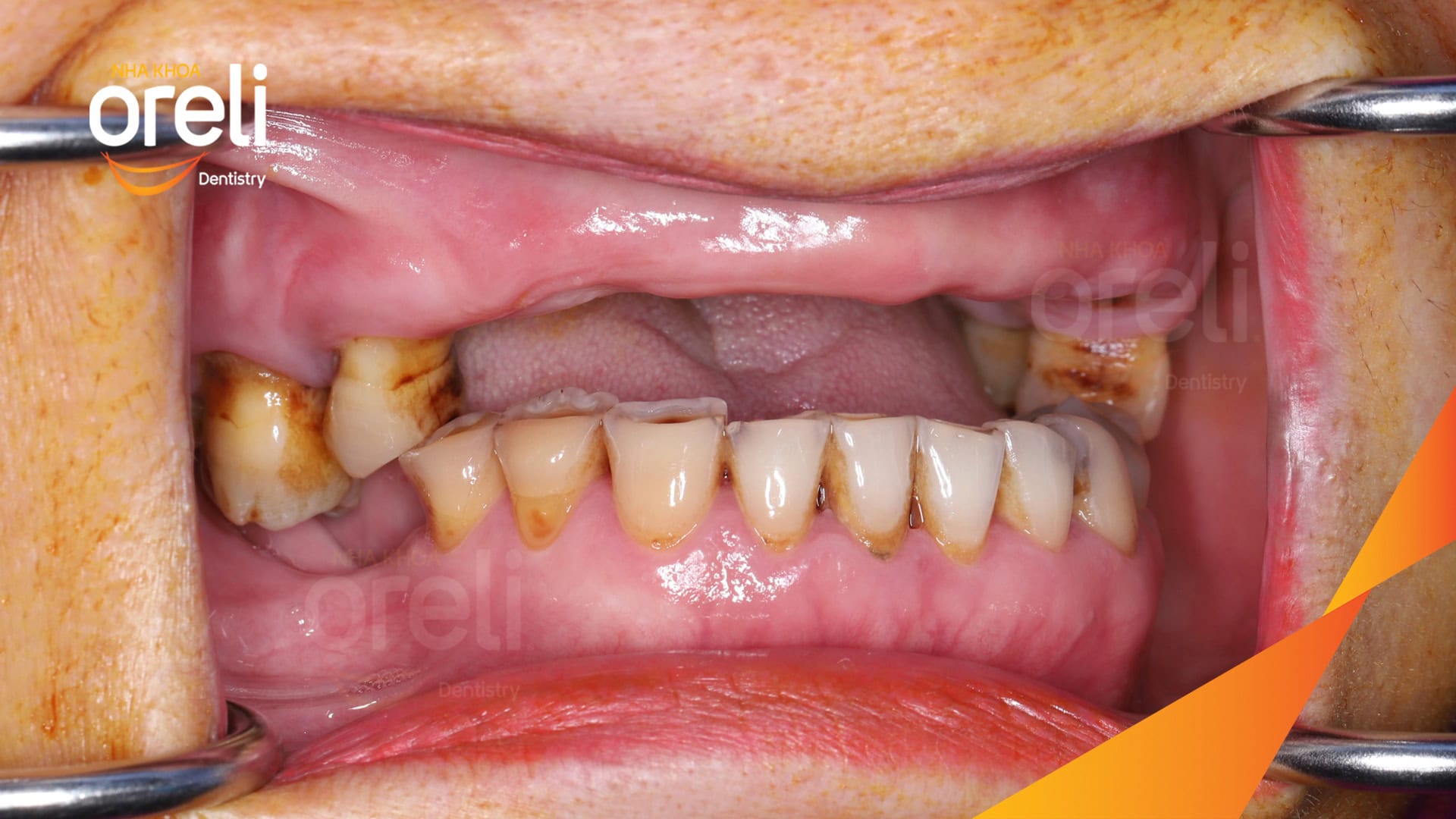 cay ghep implant toan ham tren veneer nha khoa oreli