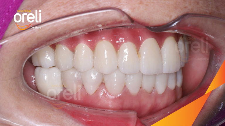 Trồng răng Implant hàm trên + Veneer hàm dưới – Phục hồi thẩm mỹ toàn diện | Oreli