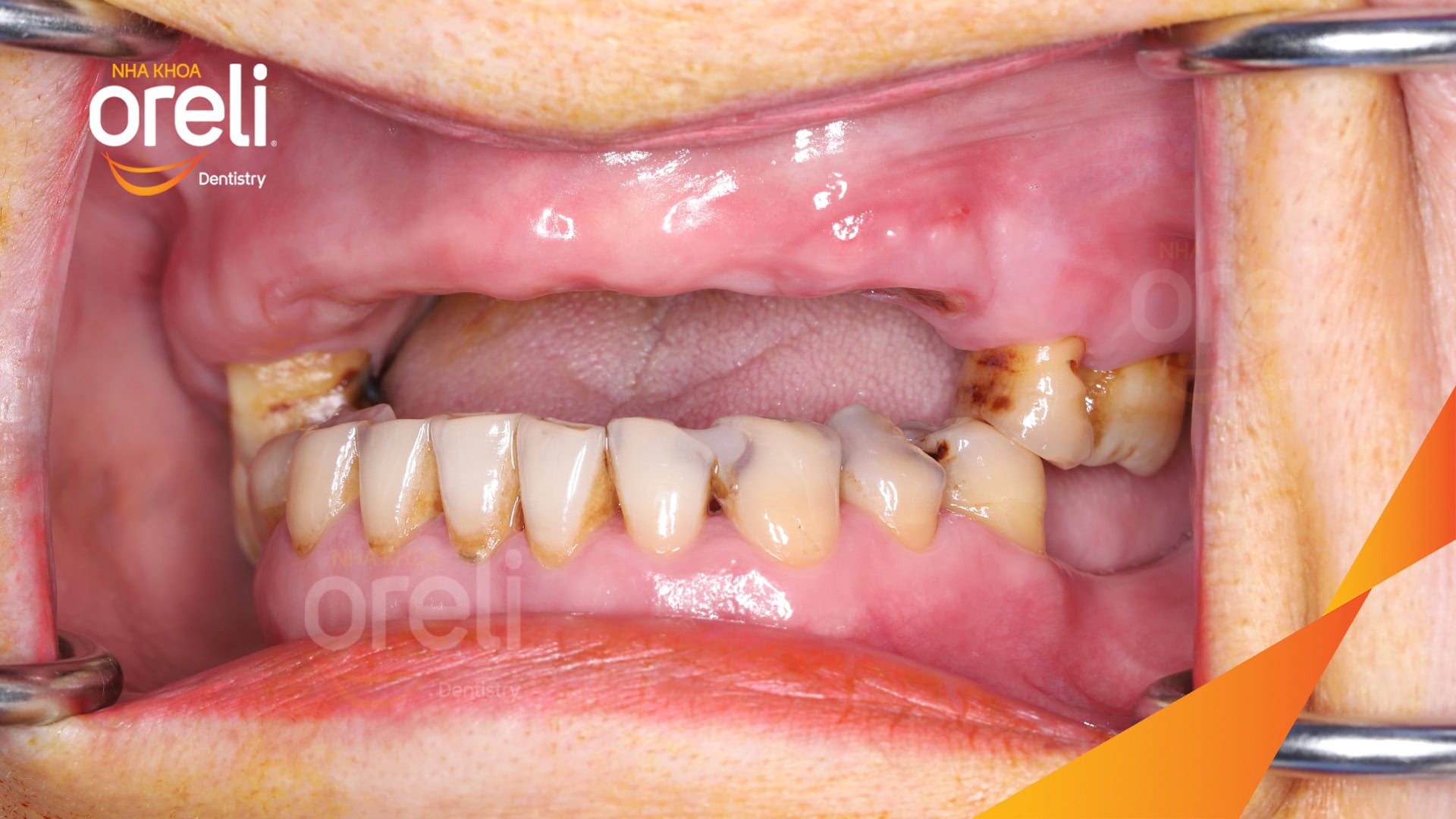 cay ghep implant toan ham tren veneer nha khoa oreli