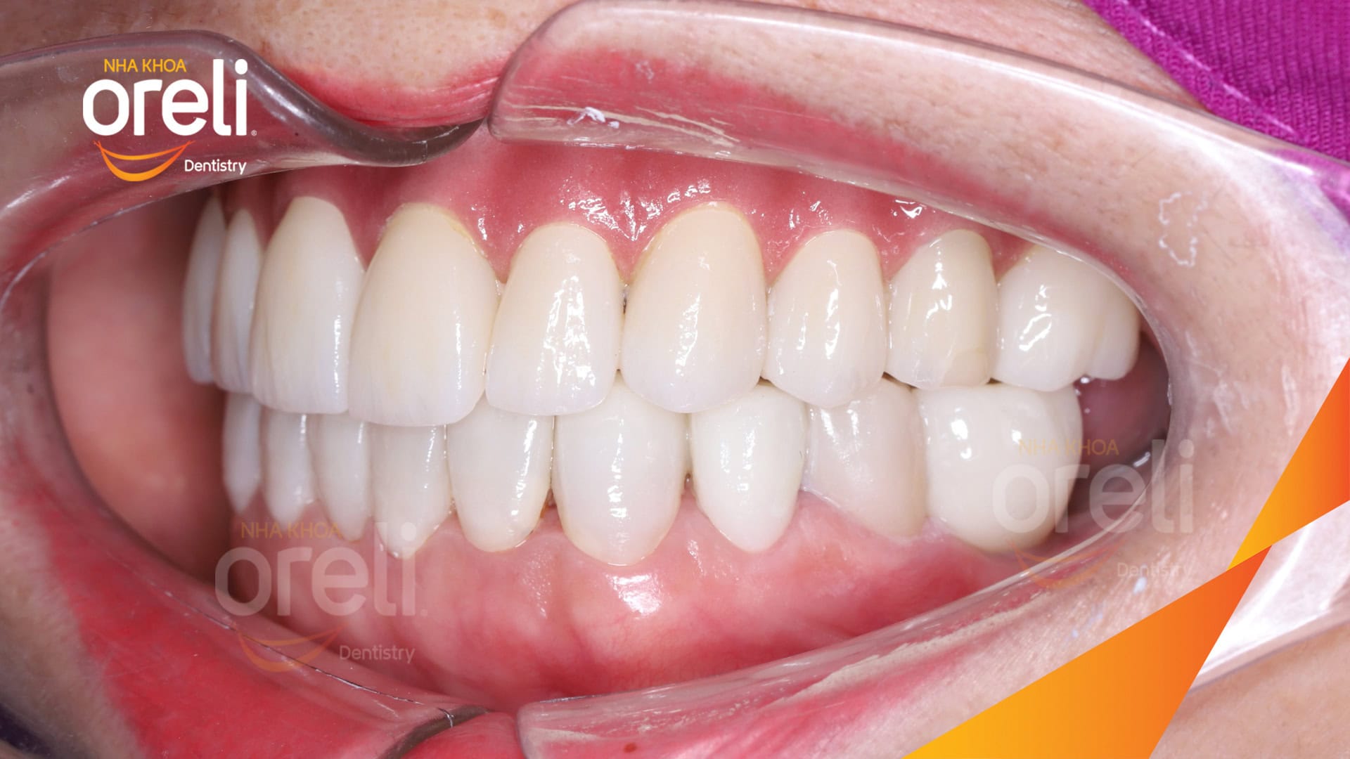 cay ghep implant toan ham tren veneer nha khoa oreli