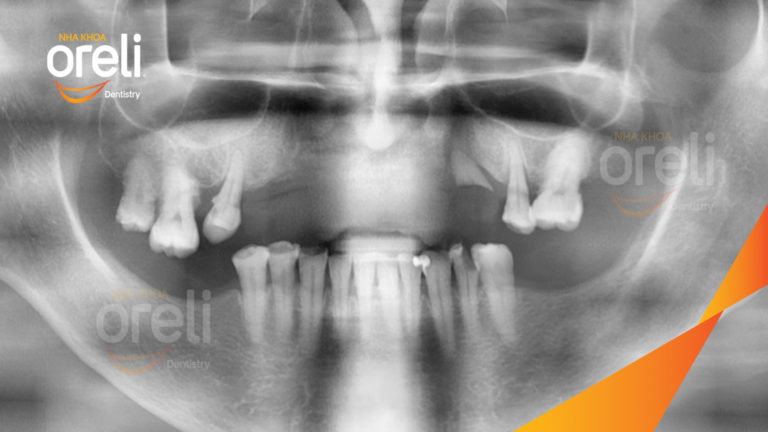 Trồng răng Implant hàm trên + Veneer hàm dưới – Phục hồi thẩm mỹ toàn diện | Oreli