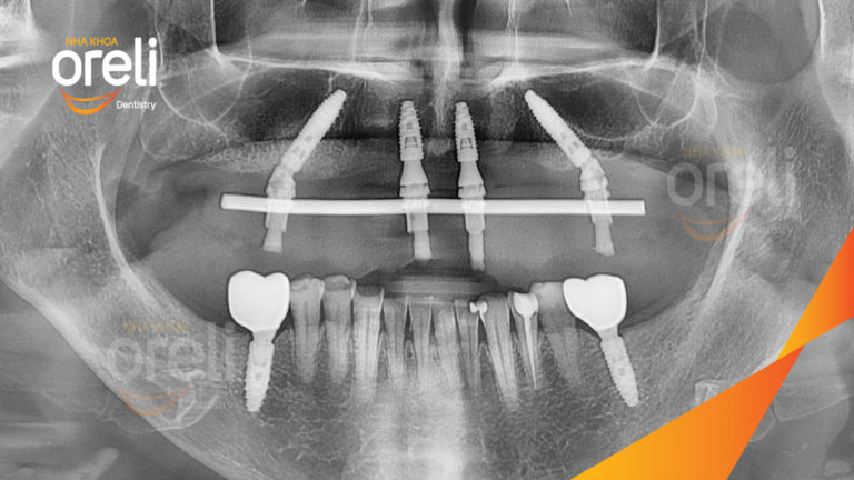 Trồng răng Implant hàm trên + Veneer hàm dưới – Phục hồi thẩm mỹ toàn diện | Oreli