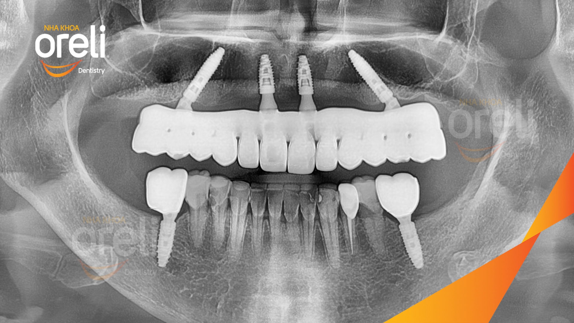 cay ghep implant toan ham tren veneer nha khoa oreli