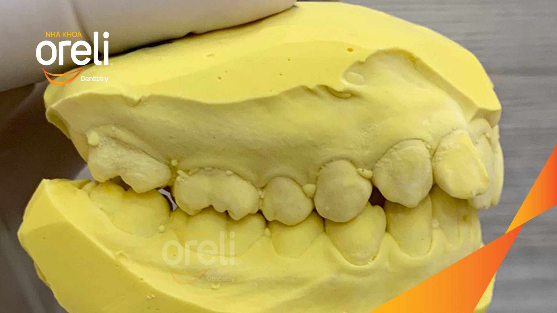 nieng rang chen chuc nha khoa oreli uy tin daklak