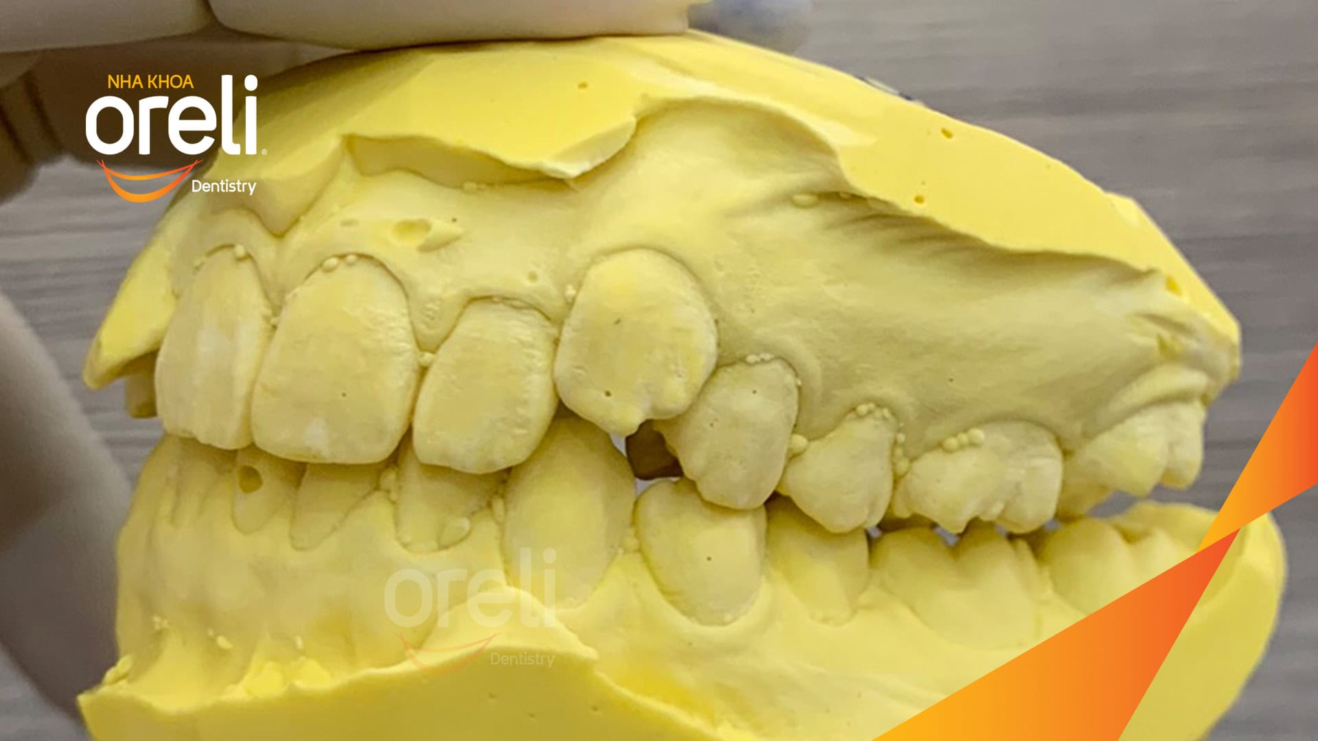 nieng rang chen chuc nha khoa oreli uy tin daklak