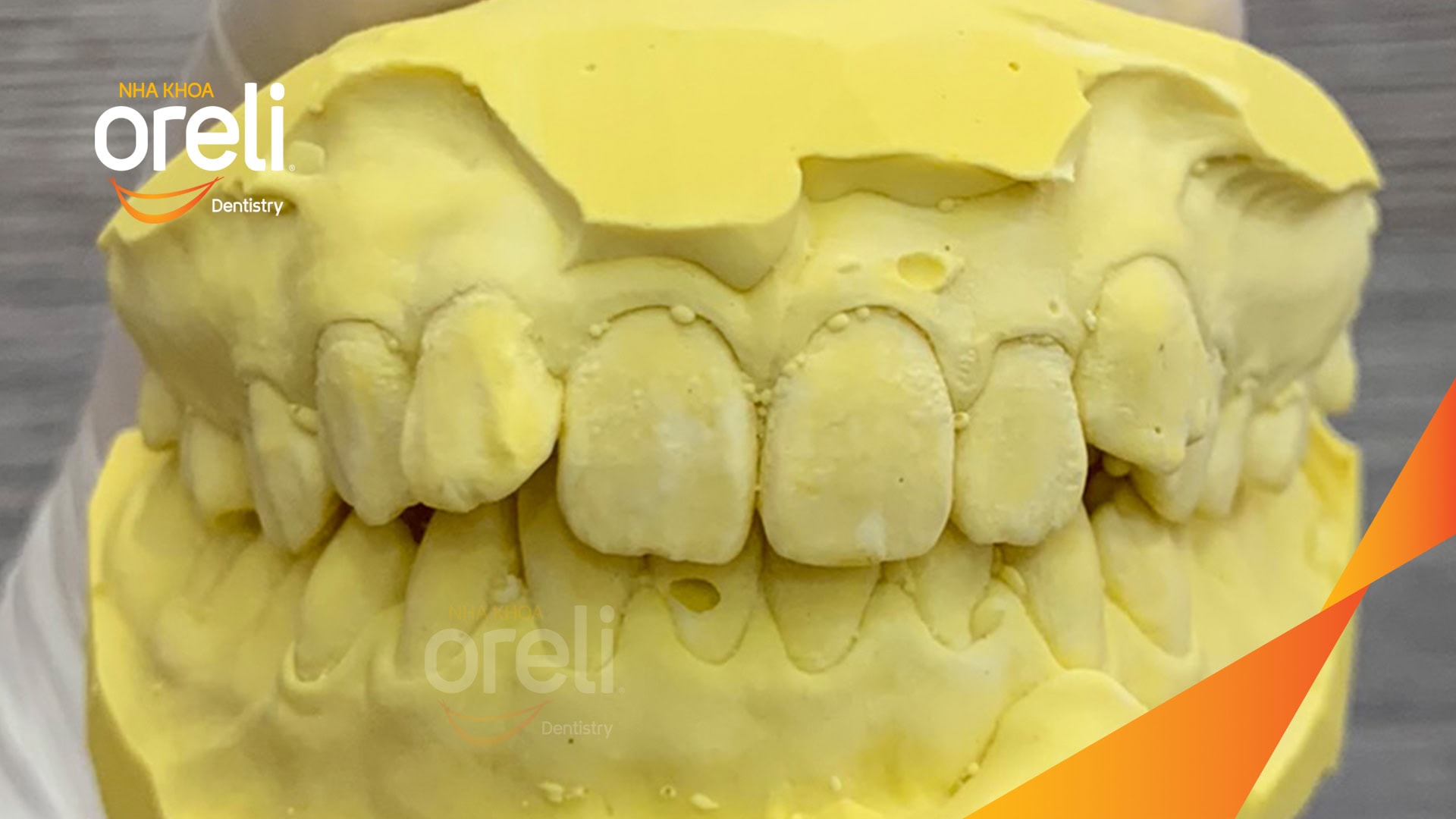 nieng rang chen chuc nha khoa oreli uy tin daklak