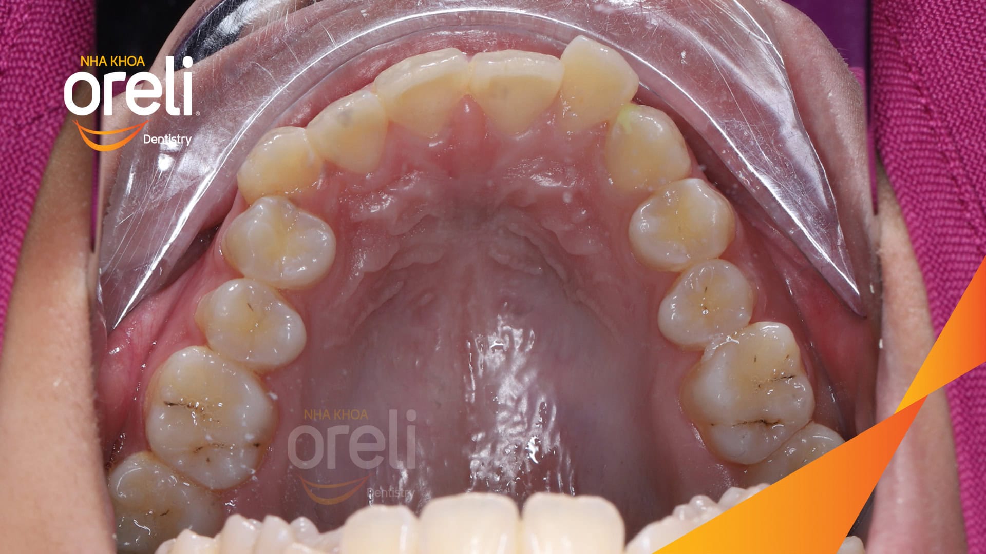 nieng rang chen chuc nha khoa oreli uy tin daklak