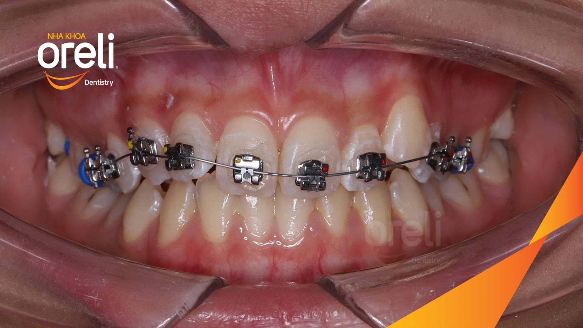 nieng rang chen chuc nha khoa oreli uy tin daklak