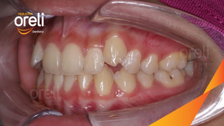 Niềng chỉnh răng chen chúc hai hàm – Kết quả thực tế sau 18 tháng tại Oreli