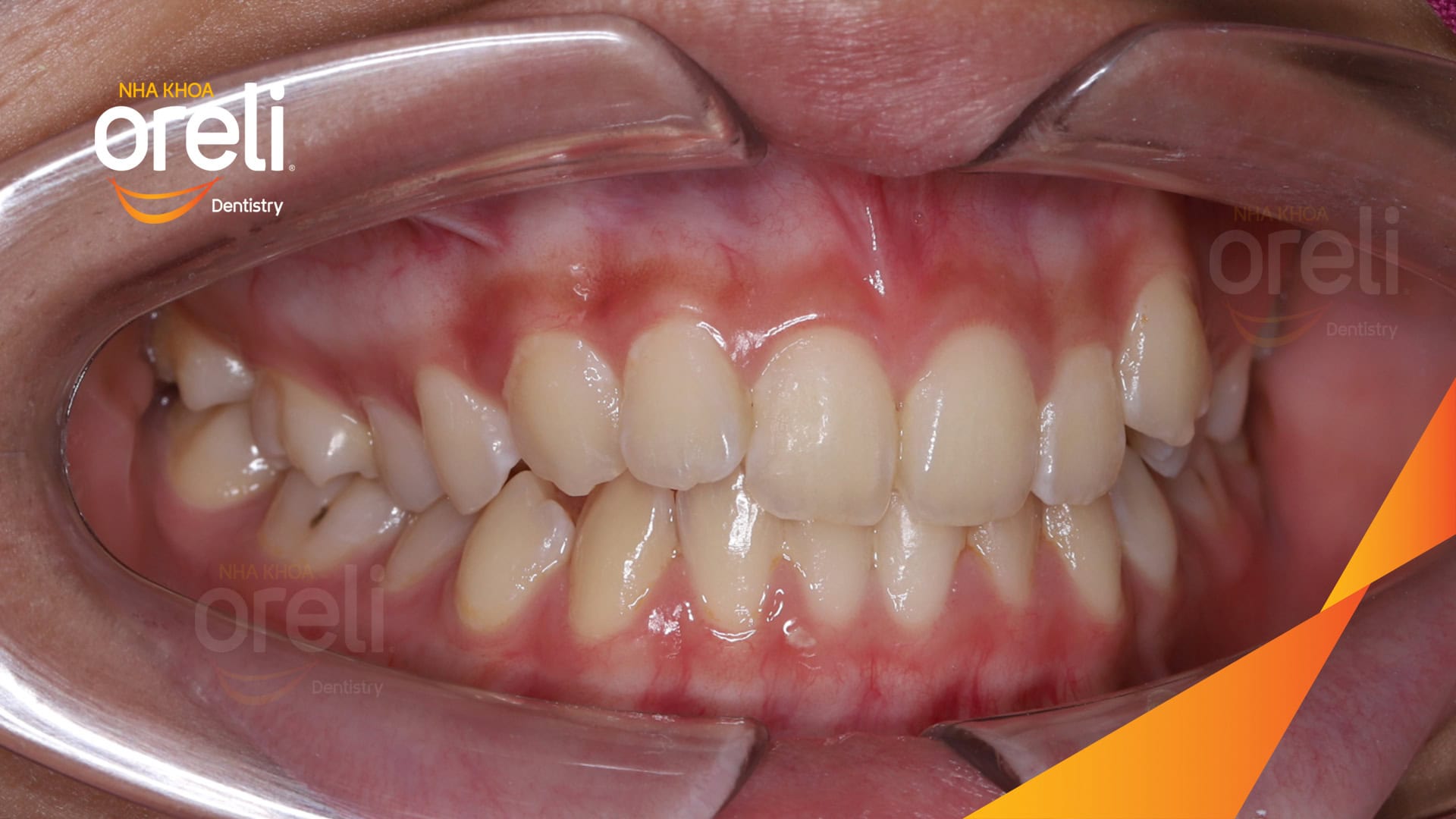 nieng rang chen chuc nha khoa oreli uy tin daklak