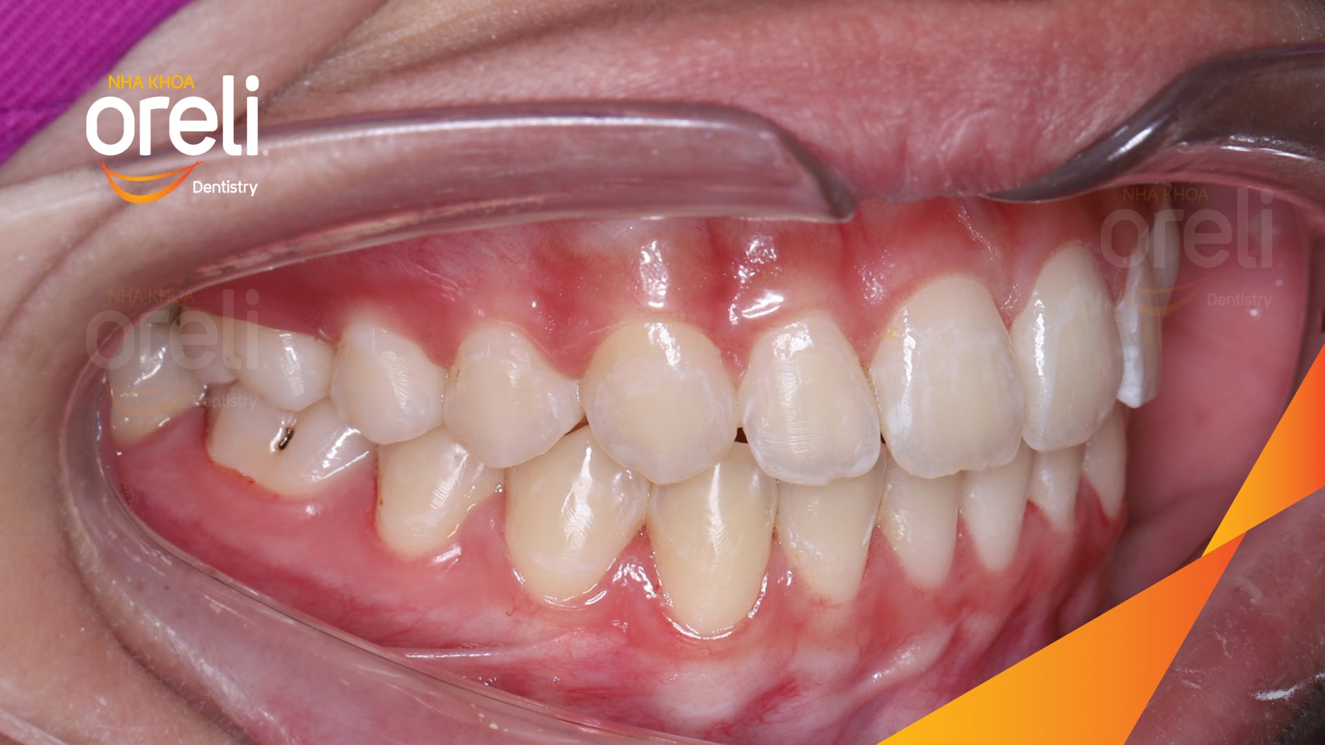 nieng rang chen chuc nha khoa oreli uy tin daklak
