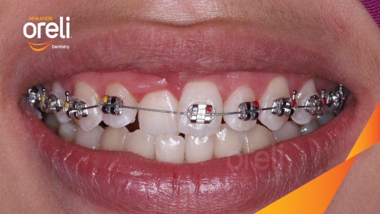 Ca niềng chỉnh cắn ngược răng cửa cho nụ cười đẹp tại Oreli