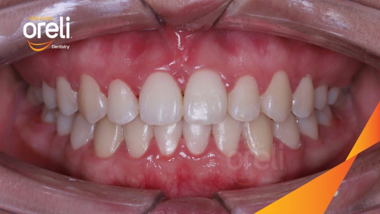Ca niềng chỉnh cắn ngược răng cửa cho nụ cười đẹp tại Oreli