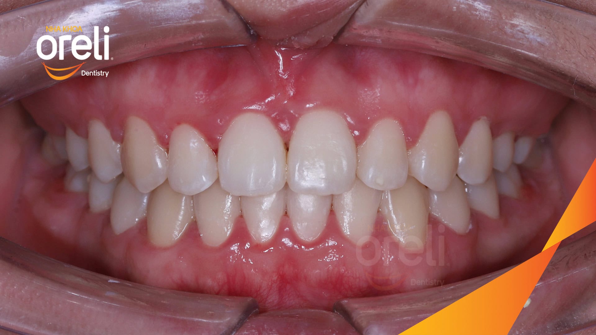 nieng chinh can nguoc rang cua nha khoa oreli