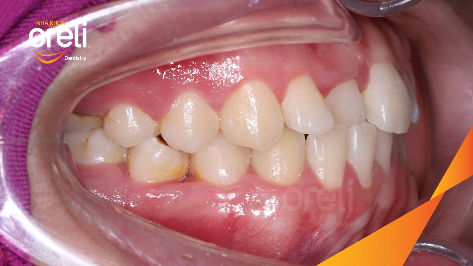 nieng chinh can nguoc rang cua nha khoa oreli