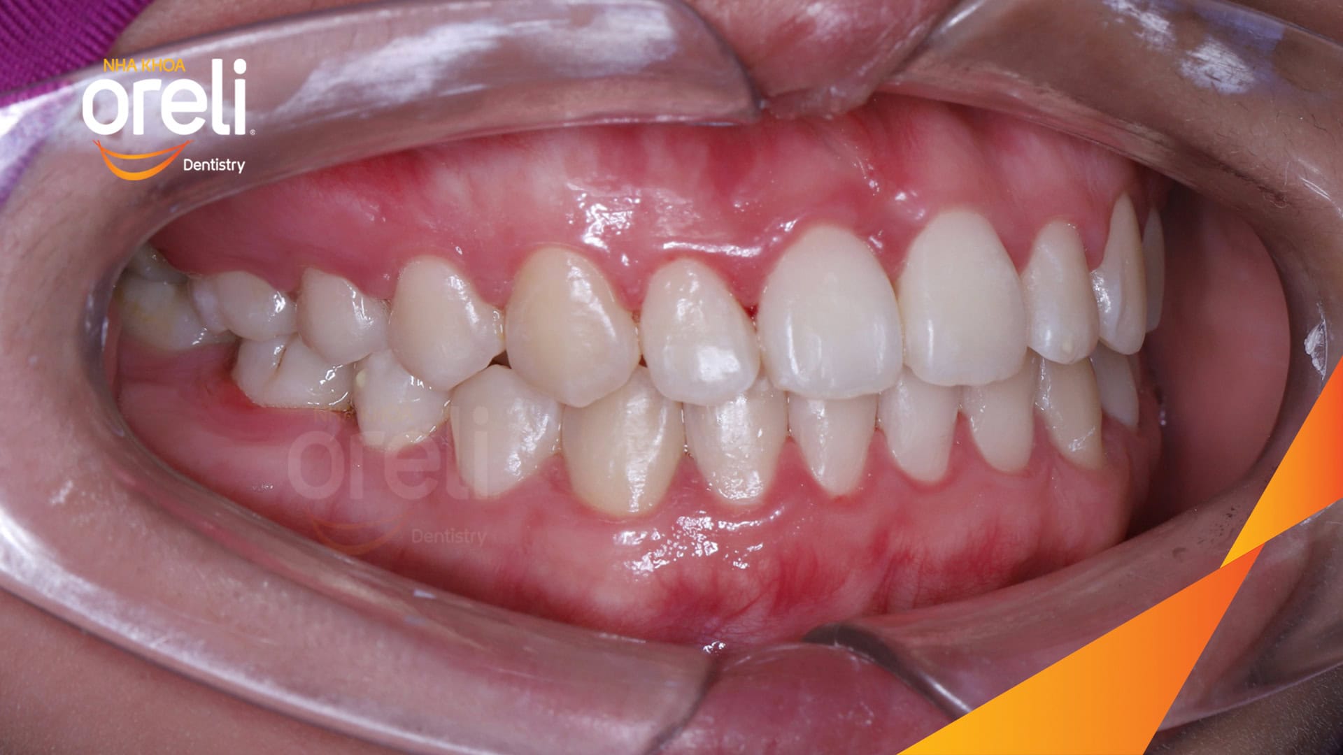 nieng chinh can nguoc rang cua nha khoa oreli