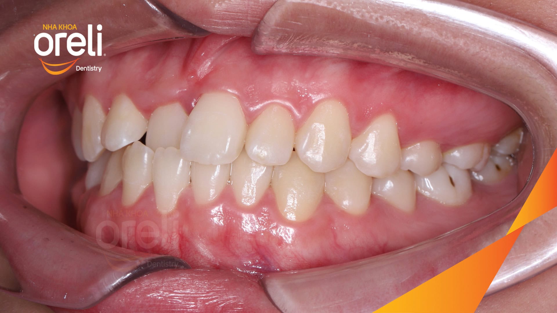 nieng chinh can nguoc rang cua nha khoa oreli