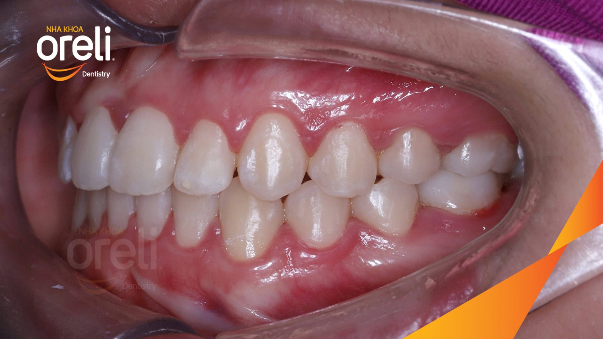 nieng chinh can nguoc rang cua nha khoa oreli