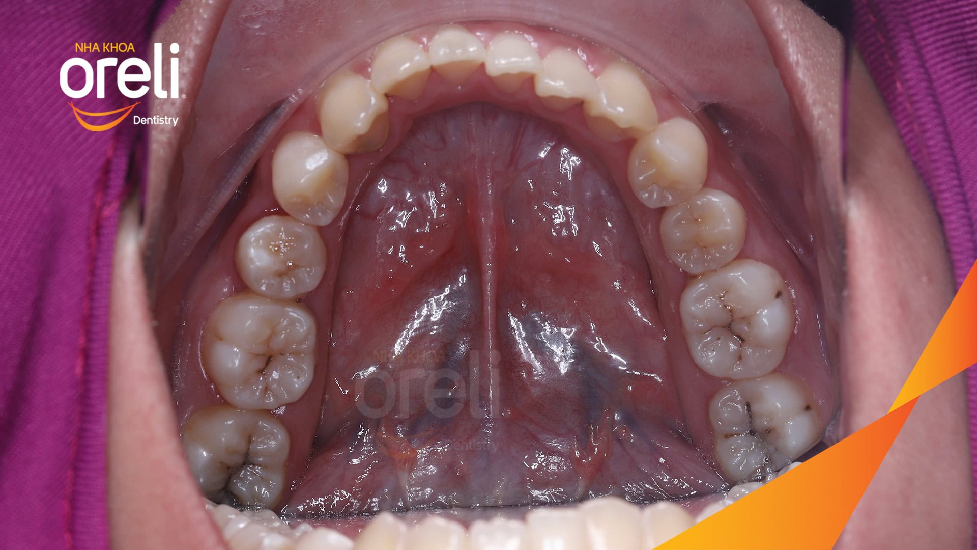 nieng chinh can nguoc rang cua nha khoa oreli