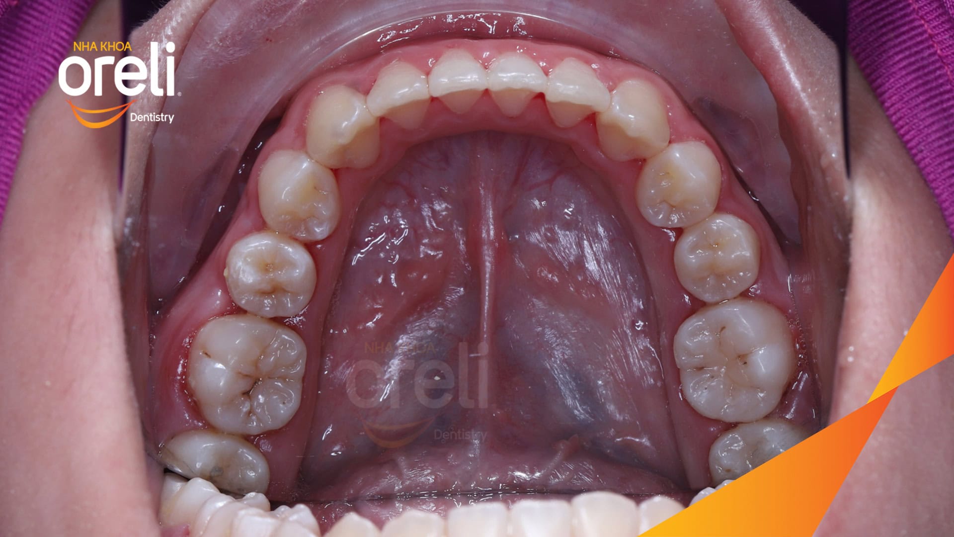 nieng chinh can nguoc rang cua nha khoa oreli