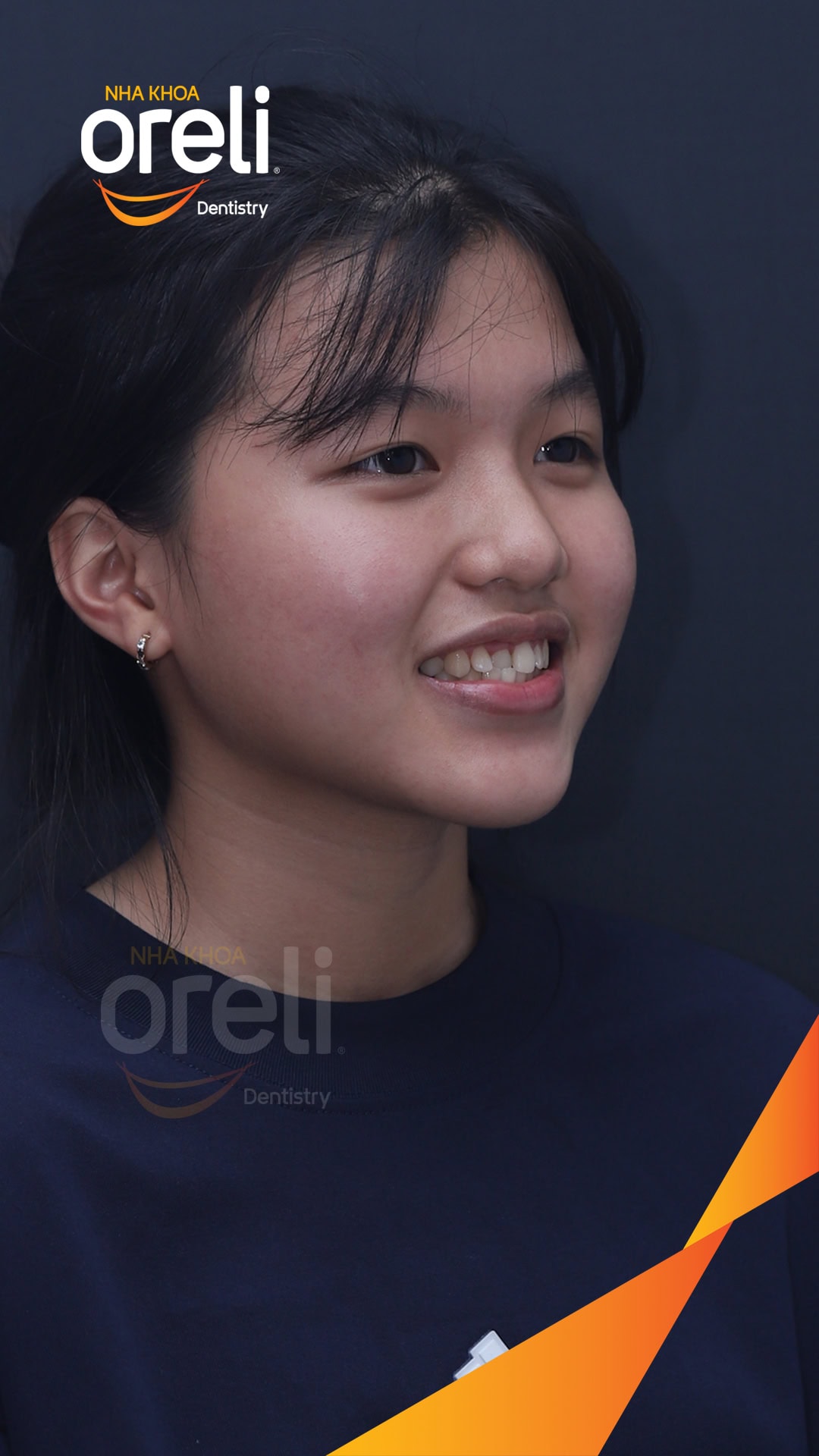 nieng chinh can nguoc rang cua nha khoa oreli