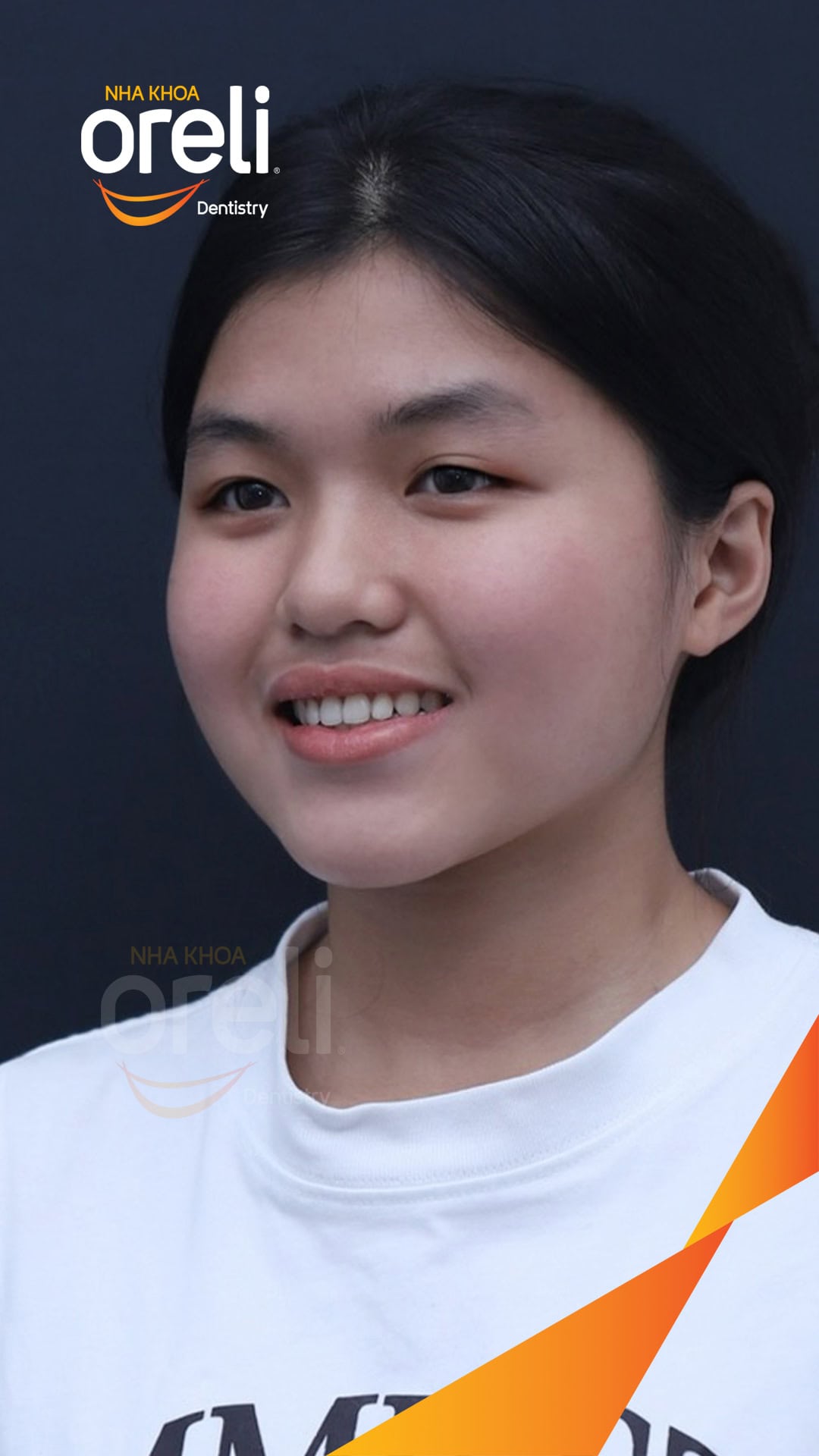 nieng chinh can nguoc rang cua nha khoa oreli