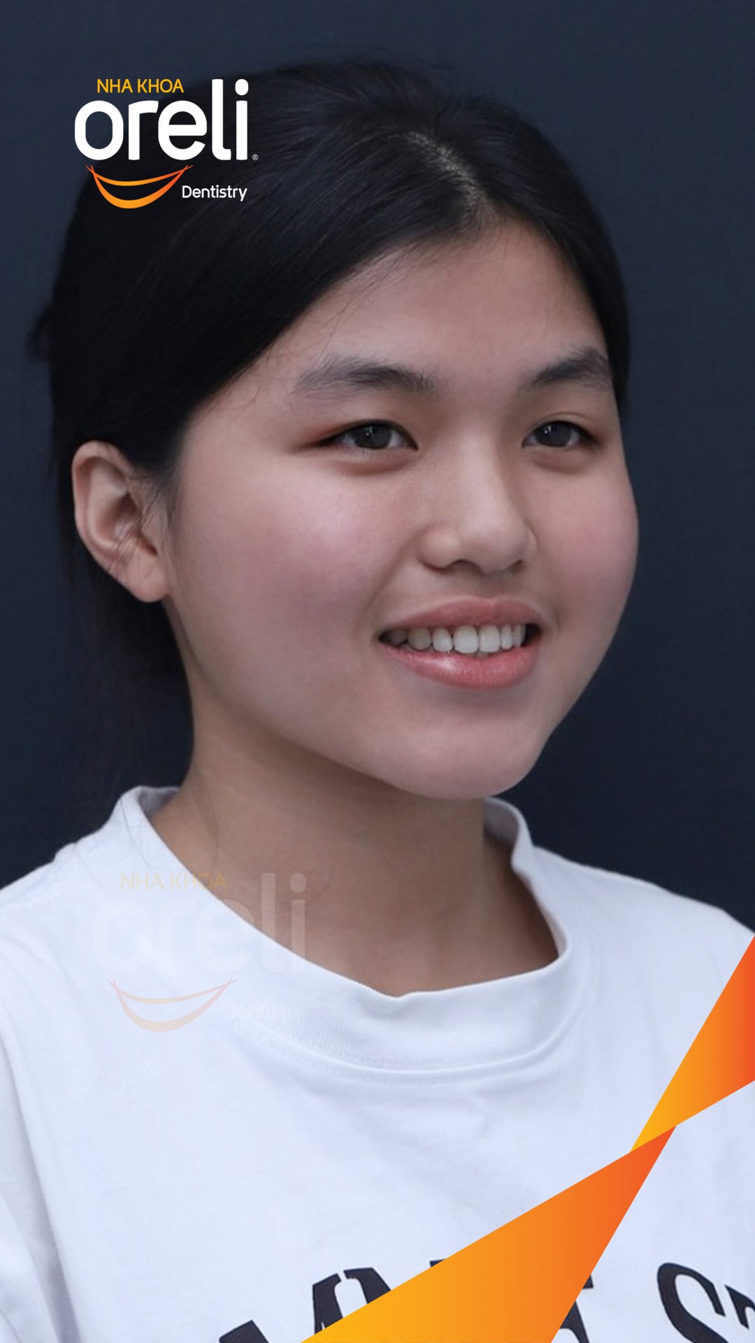 nieng chinh can nguoc rang cua nha khoa oreli