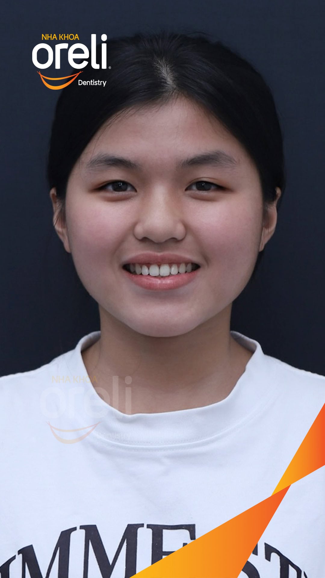 nieng chinh can nguoc rang cua nha khoa oreli