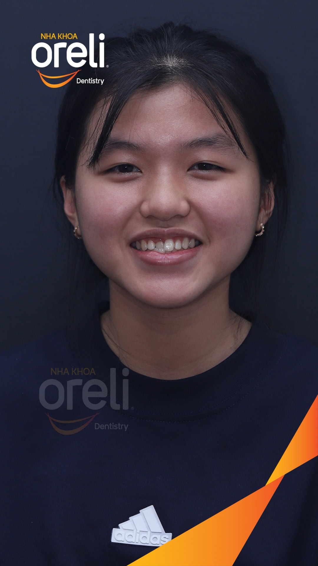 nieng chinh can nguoc rang cua nha khoa oreli