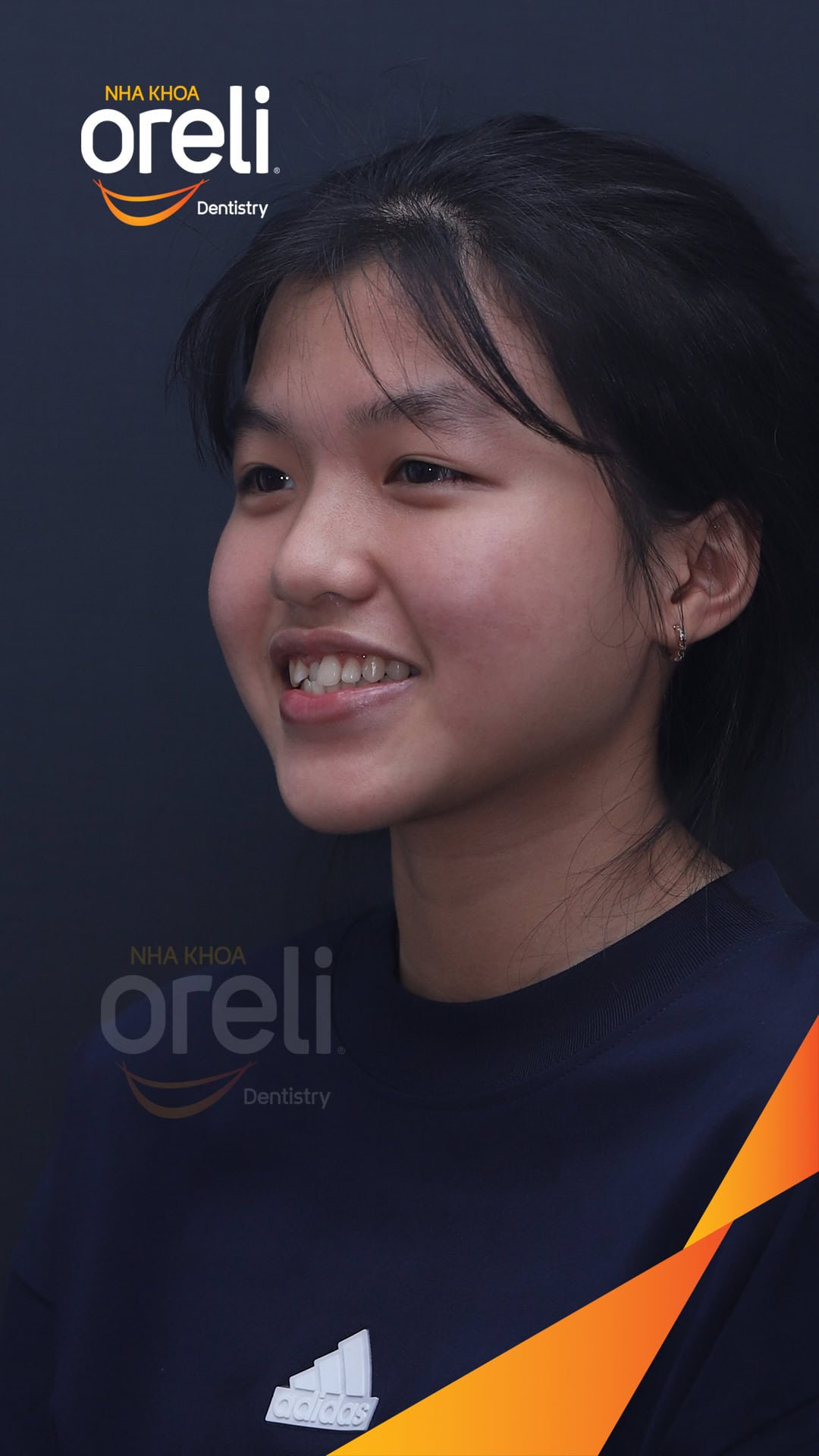 nieng chinh can nguoc rang cua nha khoa oreli