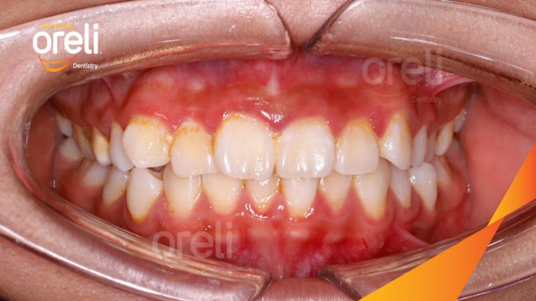 Niềng chỉnh hô kèm chen chúc hai hàm