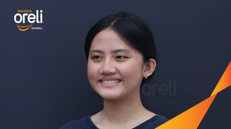 Niềng chỉnh hô kèm chen chúc hai hàm