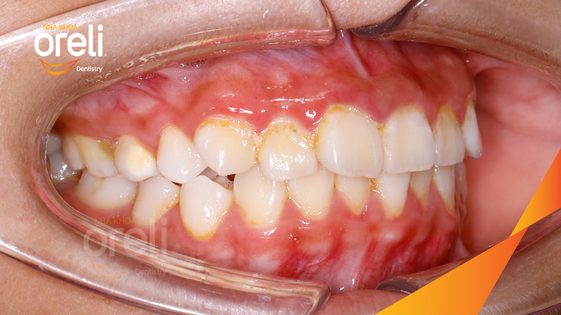 Trước điều trị:  tại Oreli
