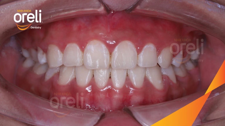 Niềng chỉnh hô kèm chen chúc hai hàm