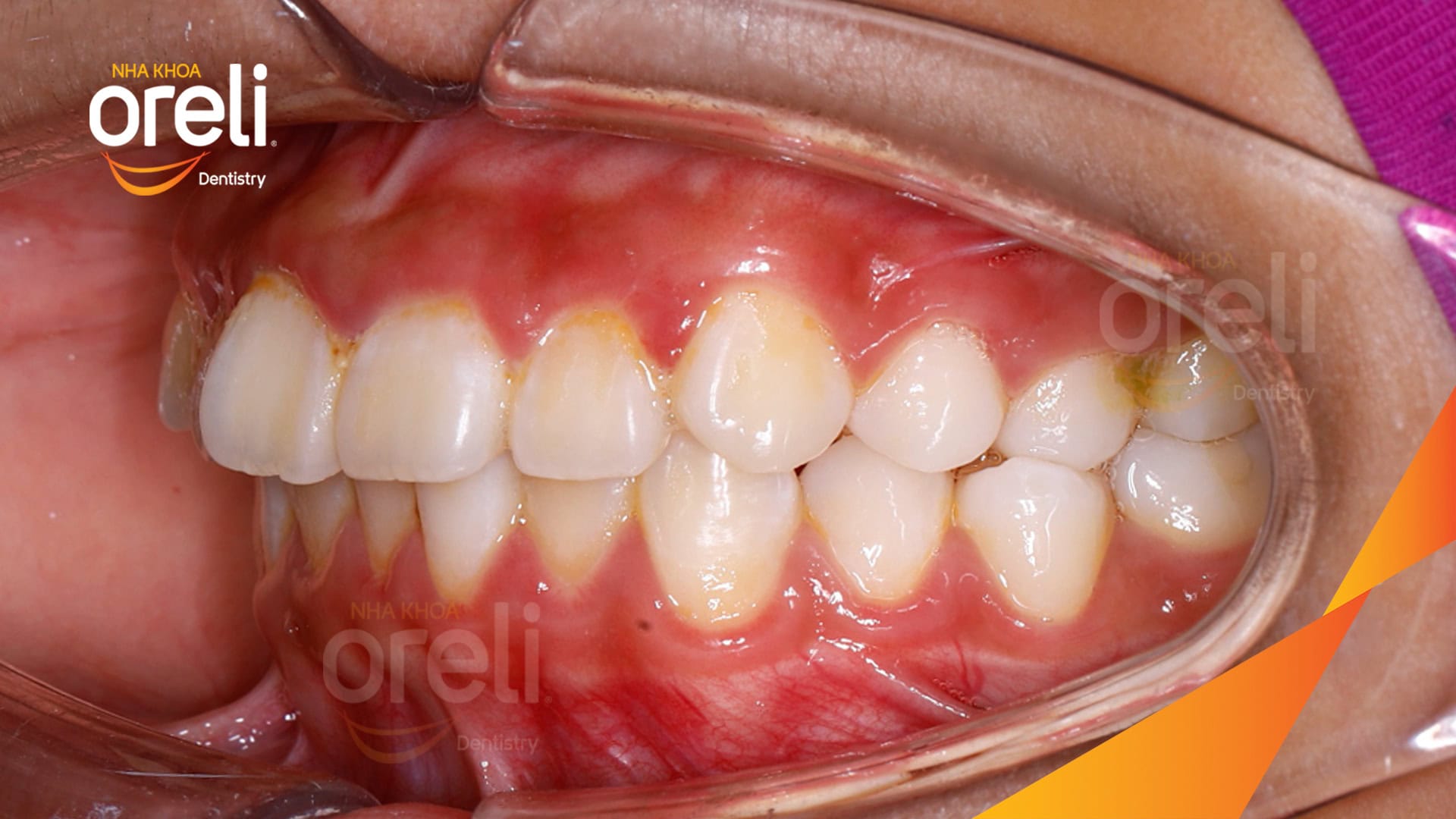 nieng rang ho chinh nha uy tin daklak nha khoa oreli