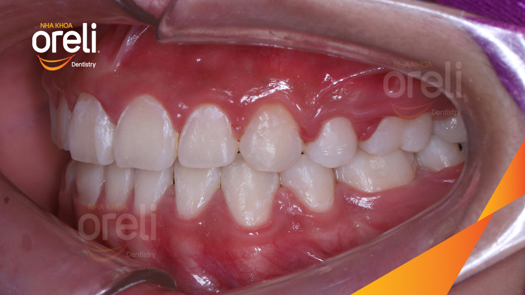 Thực hiện  kéo dài  tại Oreli