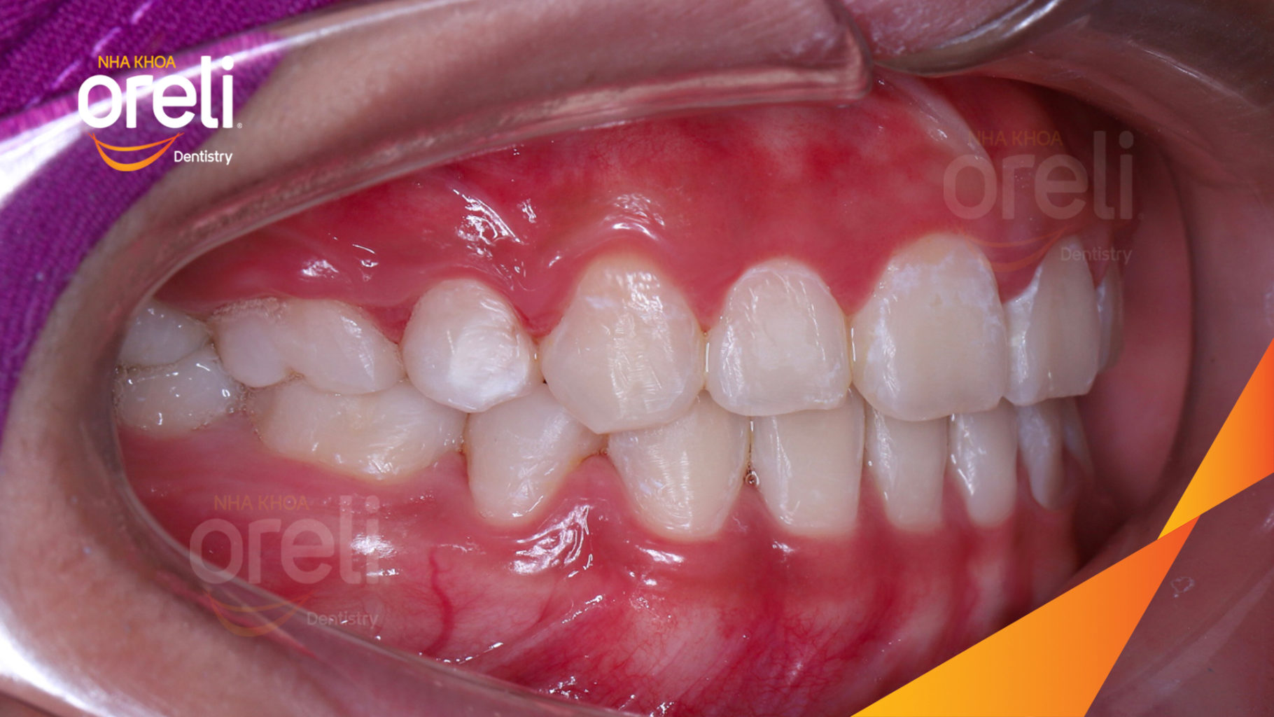  trước khi điều trị tại Oreli