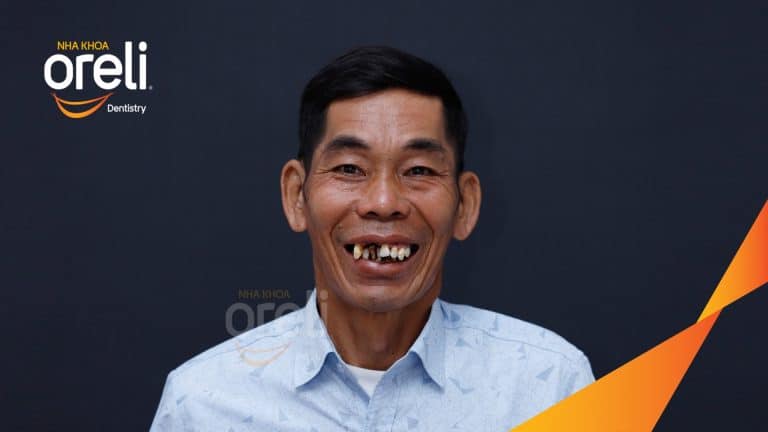 Ca trồng răng Implant chỉnh hô hai hàm tại Oreli