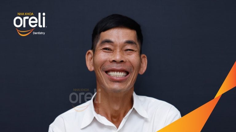 Ca trồng răng Implant chỉnh hô hai hàm tại Oreli