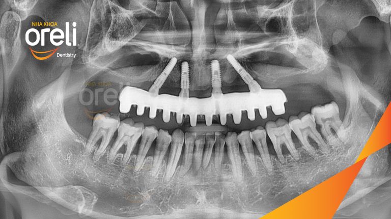 Ca trồng răng all on four hàm trên cho nụ cười đẹp ở Nha Khoa Oreli