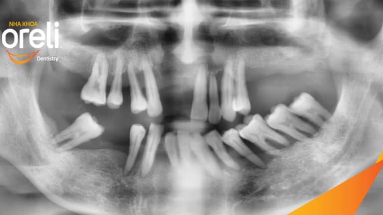 Tiêu xương hàm do mất răng lâu năm – Cách phục hồi hiệu quả bằng trồng răng Implant tại Oreli