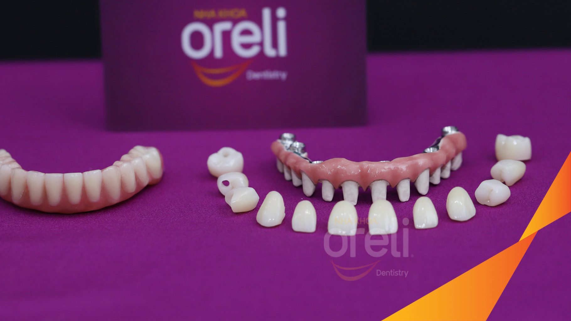 Thực hiện Trồng răng implant hai hàm với phục hình tạm kéo dài 7 ngày tại Nha khoa Oreli