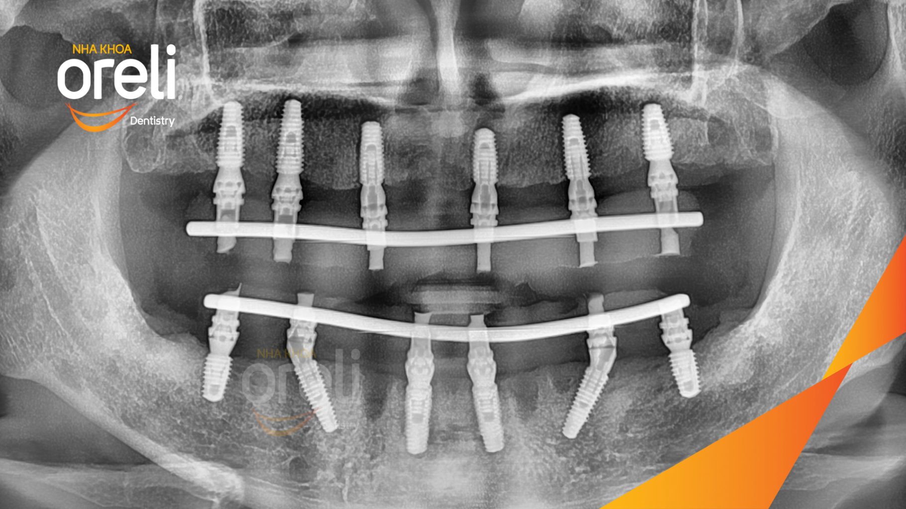 Mất răng toàn bộ hàm trên và hàm dưới trước khi điều trị tại Nha khoa Oreli